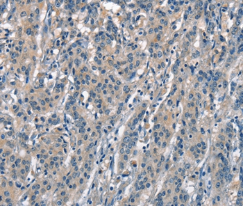 Immunohistochemical analysis of paraffin-embedded Human gastric cancer tissue using #37143 at dilution 1/30.