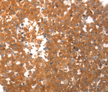 Immunohistochemical analysis of paraffin-embedded Human colon cancer tissue using #37206 at dilution 1/40.
