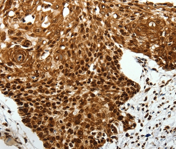 Immunohistochemical analysis of paraffin-embedded Human cervical cancer tissue using #37231 at dilution 1/40.