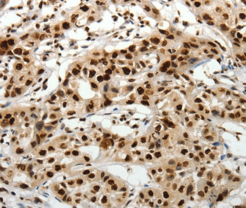 Immunohistochemical analysis of paraffin-embedded Human lung cancer tissue using #37231 at dilution 1/40.