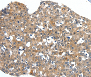Immunohistochemical analysis of paraffin-embedded Human esophagus cancer tissue using #37235 at dilution 1/40.
