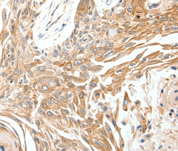 Immunohistochemical analysis of paraffin-embedded Human breast cancer tissue using #37235 at dilution 1/40.