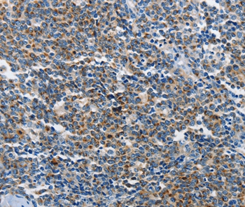 Immunohistochemical analysis of paraffin-embedded Human lymphoma tissue using #37377 at dilution 1/25.
