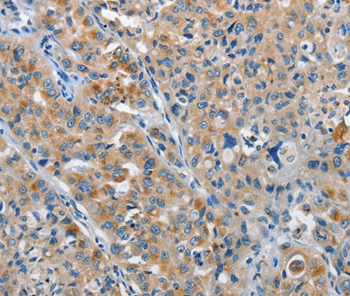 Immunohistochemical analysis of paraffin-embedded Human lung cancer tissue using #37377 at dilution 1/25.