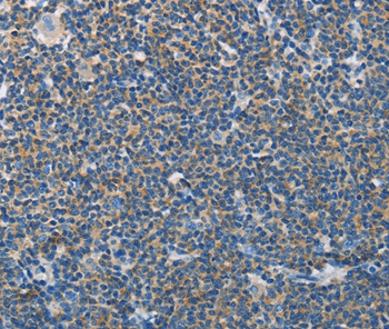 Immunohistochemical analysis of paraffin-embedded Human lymphoma tissue using #37379 at dilution 1/60.