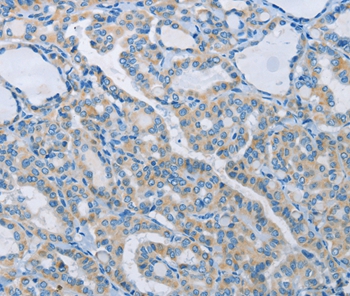 Immunohistochemical analysis of paraffin-embedded Human thyroid cancer tissue using #37379 at dilution 1/60.