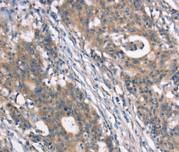 Immunohistochemical analysis of paraffin-embedded Human gastric cancer tissue using #37388 at dilution 1/40.