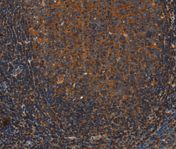 Immunohistochemical analysis of paraffin-embedded Human tonsil cancer tissue using #37434 at dilution 1/25.
