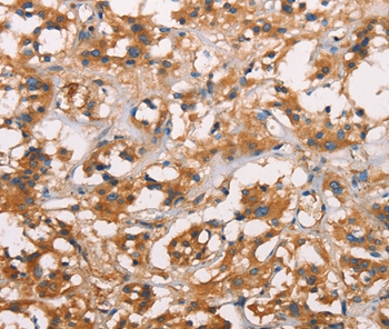Immunohistochemical analysis of paraffin-embedded Human thyroid cancer tissue using #37434 at dilution 1/25.