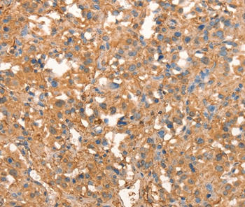 Immunohistochemical analysis of paraffin-embedded Human thyroid cancer tissue using #37502 at dilution 1/40.