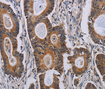 Immunohistochemical analysis of paraffin-embedded Human colon cancer tissue using #37798 at dilution 1/40.