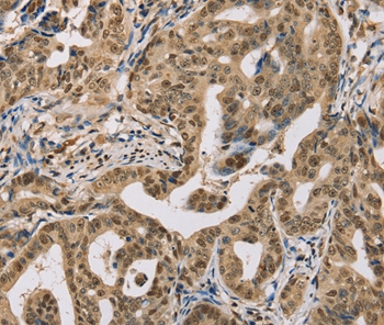 Immunohistochemical analysis of paraffin-embedded Human gastric cancer tissue using #37846 at dilution 1/30.