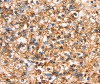 Immunohistochemical analysis of paraffin-embedded Human prostate cancer tissue using #37940 at dilution 1/20.