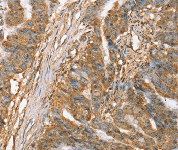 Immunohistochemical analysis of paraffin-embedded Human esophagus cancer tissue using #37945 at dilution 1/45.