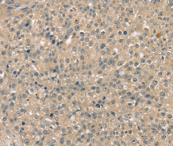 Immunohistochemical analysis of paraffin-embedded Human breast cancer tissue using #37954 at dilution 1/40.