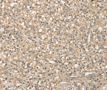 Immunohistochemical analysis of paraffin-embedded Human prostate cancer tissue using #37954 at dilution 1/40.