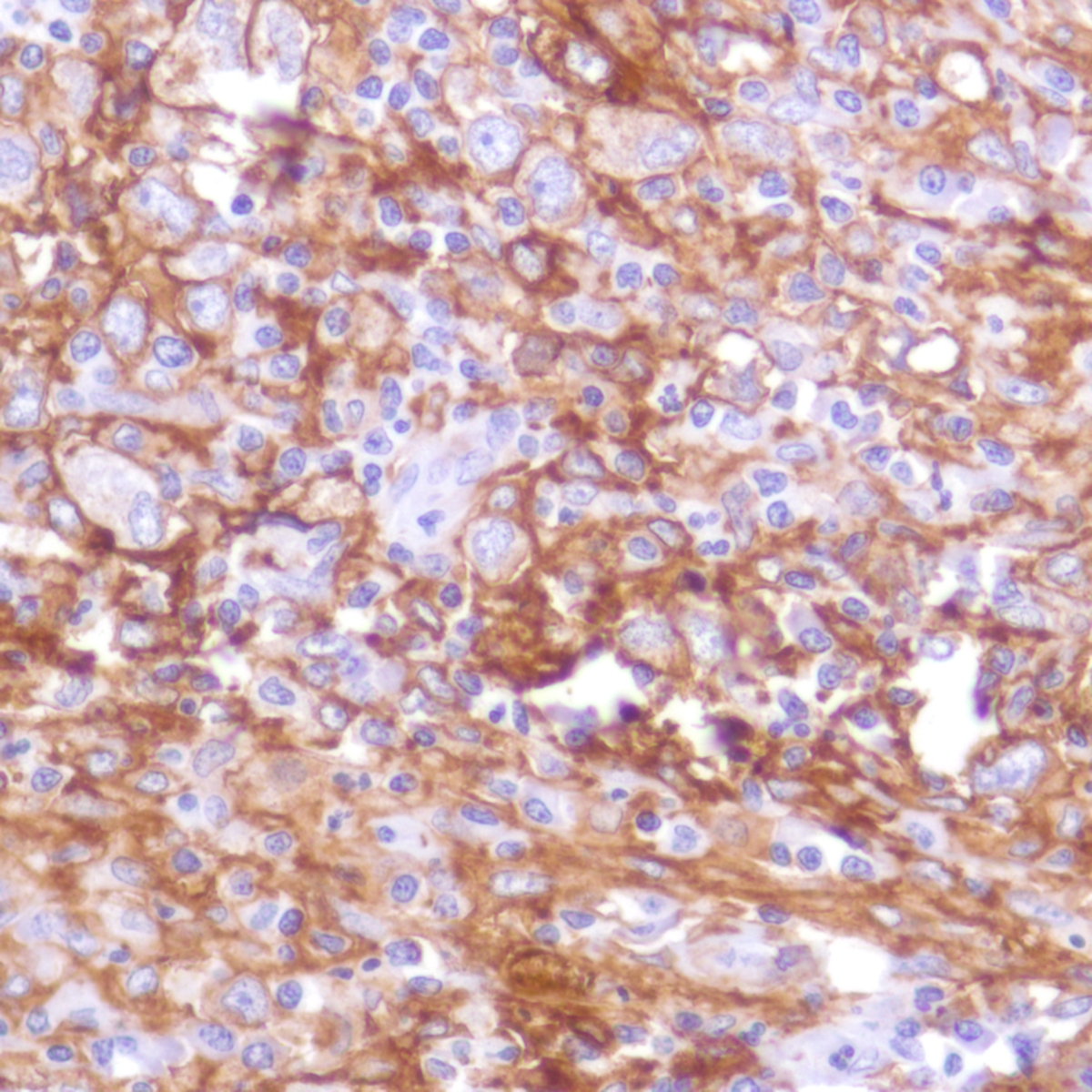 Human Hodgkin's lymphoma stained with anti-PD-L1 antibody