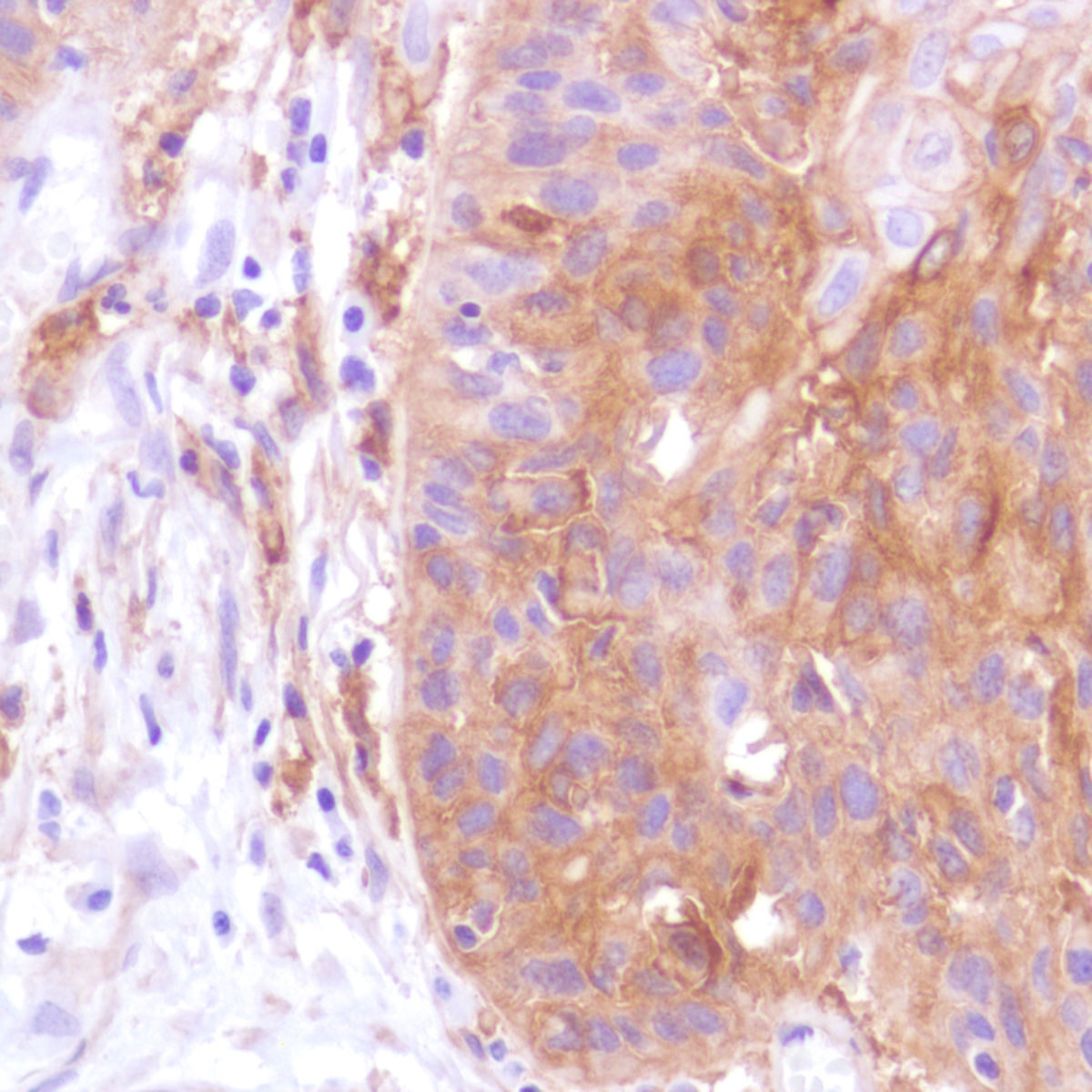 Human cervical squamous cell carcinoma stained with anti-PD-L1 antibody