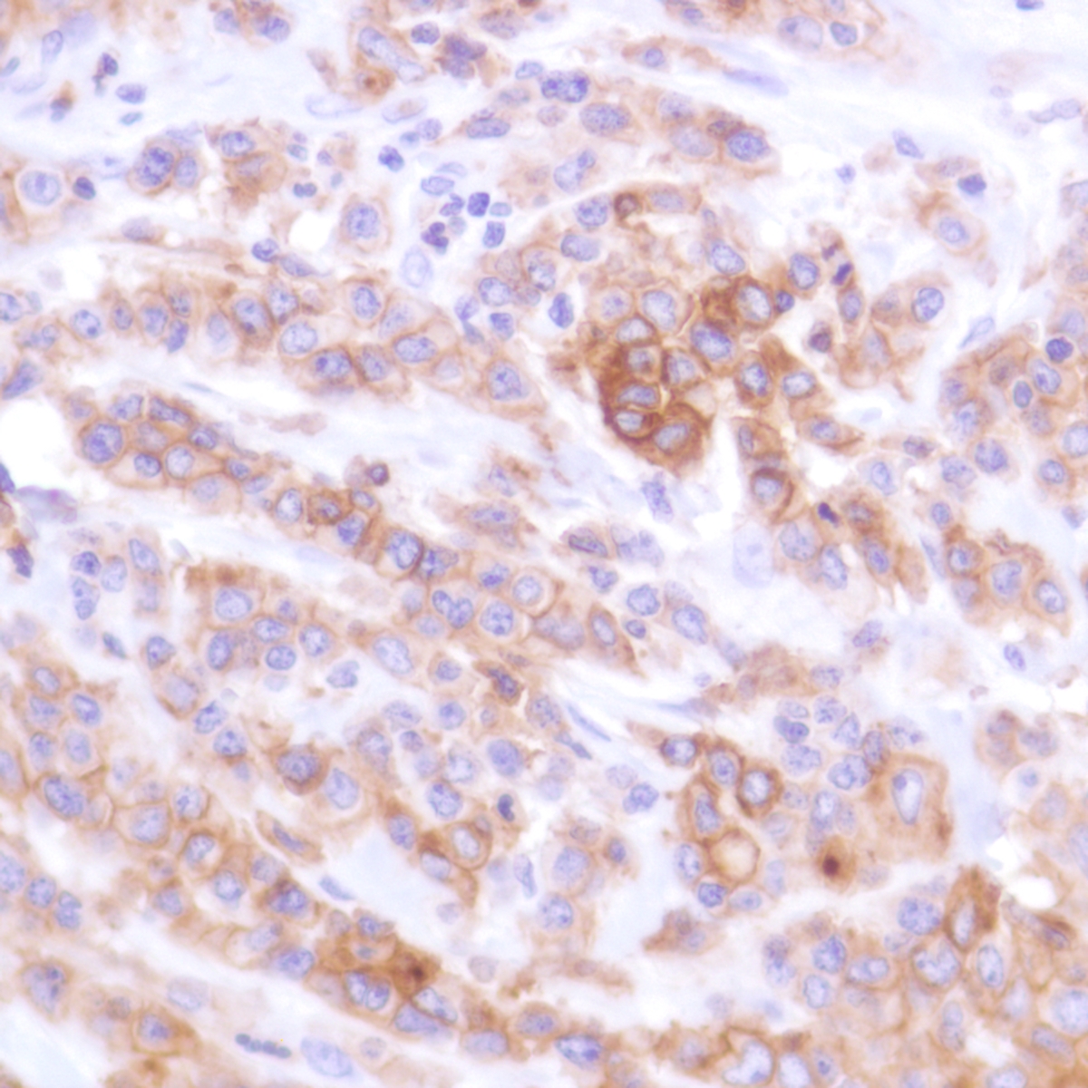 Human pancreatic adenocarcinoma stained with anti-PD-L1 antibody