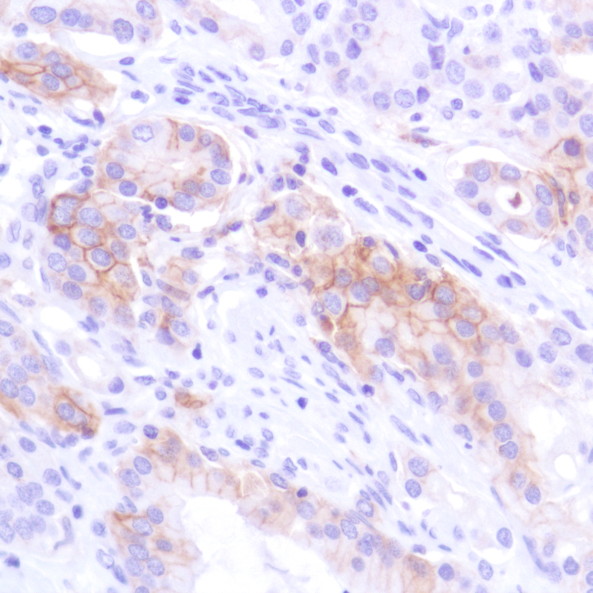 Human prostate adenocarcinoma stained with anti-PD-L1 antibody