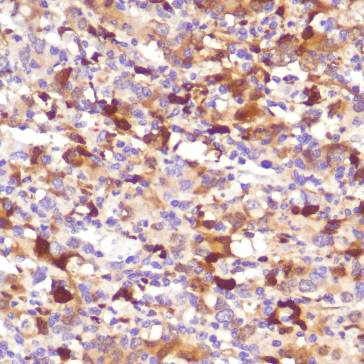 Human stomach adenocarcinoma stained with anti-IDO-1 antibody