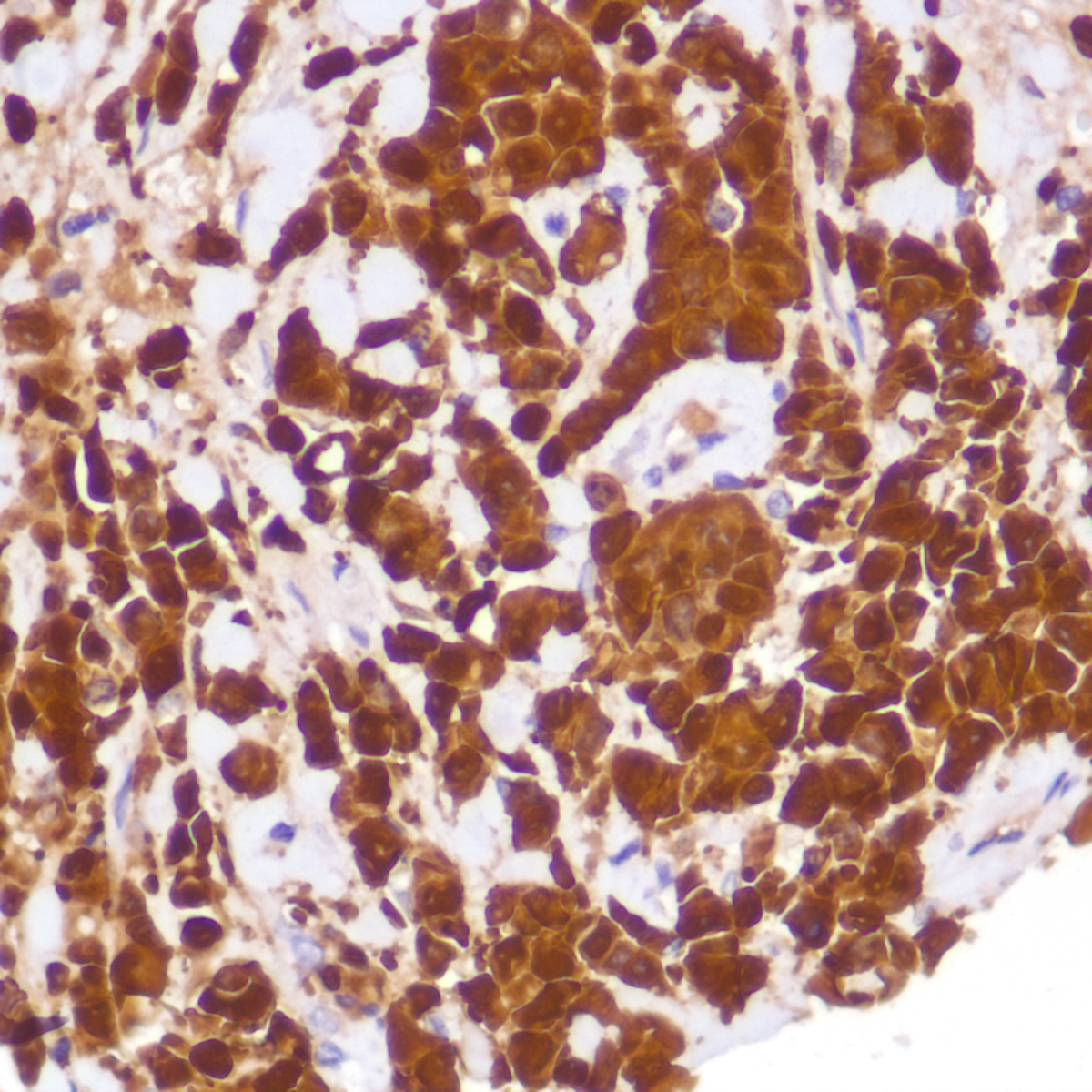 Human pancreatic adenocarcinoma stained with anti-IDO-1 antibody
