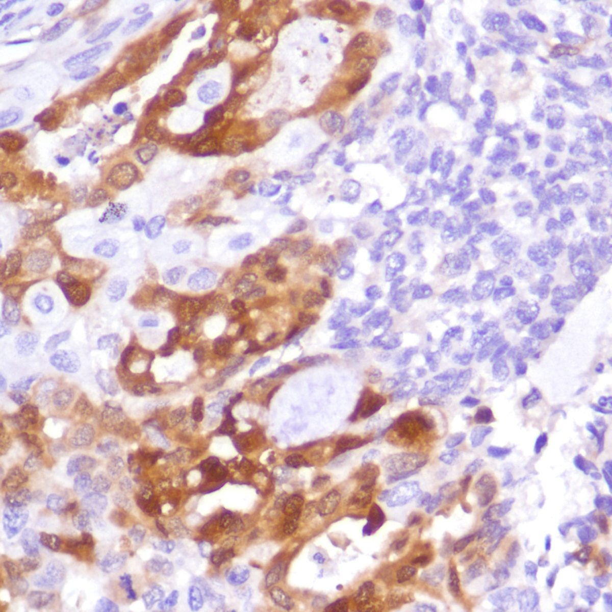 Human endometrial adenocarcinoma stained with anti-IDO-1 antibody