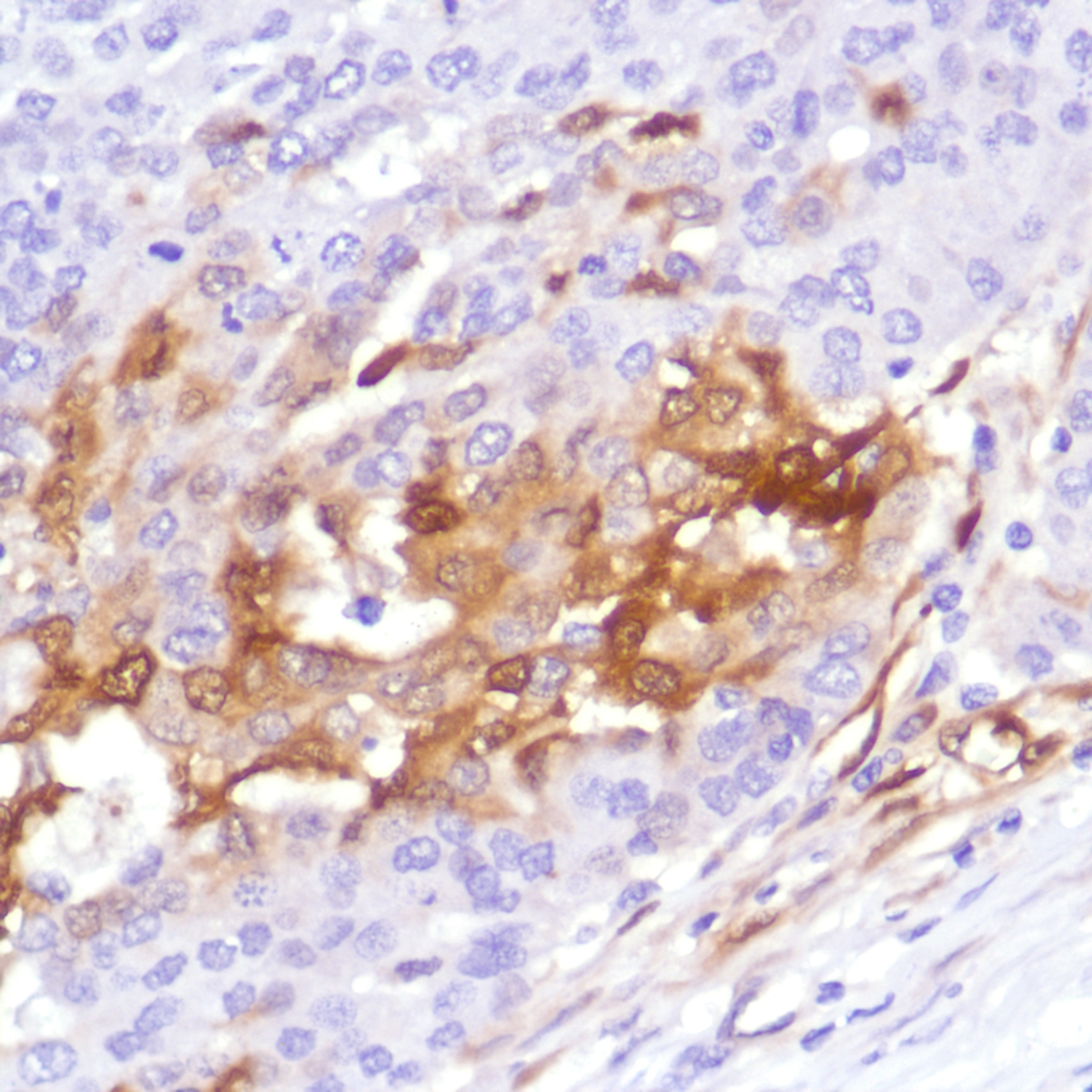 Human ovarian adenocarcinoma stained with anti-IDO-1 antibody
