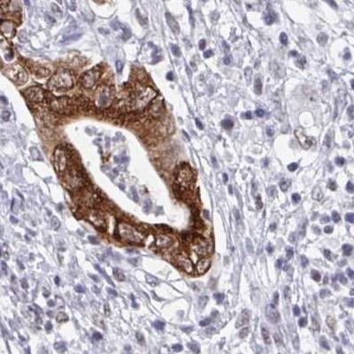 Immunohistochemistry: Suppressor of Ty 4 homolog 1 Antibody [NBP2-31794] - pancreatic cancer