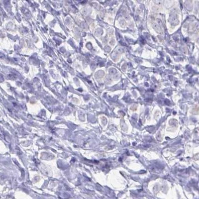 Immunohistochemistry: Glycine Receptor alpha 1 + alpha 2 Antibody [NBP2-31561] - breast cancer