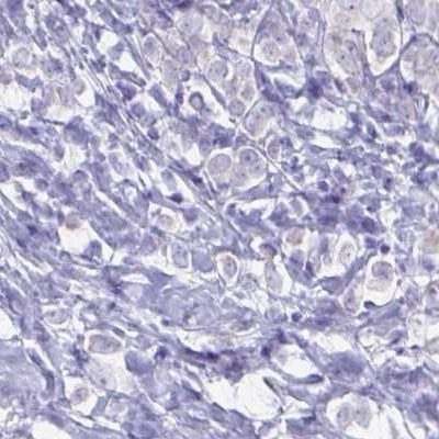 Immunohistochemistry: Glycine Receptor alpha 1 + alpha 2 Antibody [NBP2-31561] - breast cancer