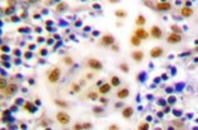 Immunohistochemistry-Paraffin: Retinoid X Receptor gamma Antibody [NB100-91953] - Human lymph node breast carcinoma tonsil tissue.