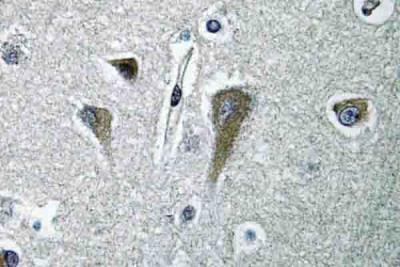 Immunohistochemistry-Paraffin: Eukaryotic translation initiation factor 5B Antibody [NBP1-30511] - Analyzes of eIF5B (H1086) pAb in paraffin-embedded human breast carcinoma tissue.