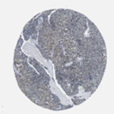 Immunohistochemistry: SETD5 Antibody [22560002] - Strong cytoplasmic and nuclear staining was observed in glandular cells of the gastrointestinal tract, parathyroid and thyroid glands, adrenal cortex and upper airway epithelium. The remaining normal tissues generally displayed weak to moderate nuclear and/or cytoplasmic positivity. Cells of the liver were negative. Among tumors, most cases showed weak to moderate nuclear and/or cytoplasmic positivity. Some malignant gliomas and malignant carcinoids showed strong nuclear staining. Most renal and endometrial cancers were negative.  Image and statement courtesy of the Human Protein Atlas (HPA).