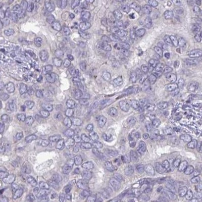 Immunohistochemistry: C2orf53 Antibody [NBP2-32417] - liver cancer