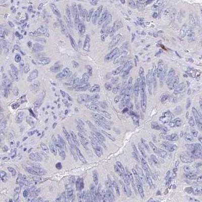 Immunohistochemistry: C4orf17 Antibody [NBP2-31819] - colorectal cancer