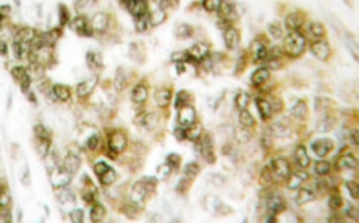 Immunohistochemistry: TBX15/18 Antibody [NB100-92302] - Immunohistochemistry (IHC) analyzes of TBX15/18  (D164) antibody in paraffin-embedded human breast  carcinoma tissue.