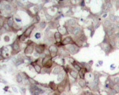 Immunohistochemistry-Paraffin: Cortactin Antibody [NBP1-19881] - Paraffin-embedded human breast carcinoma tissue.