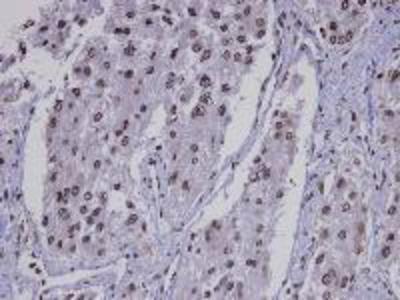 Immunohistochemistry: Immunohistochemical analysis of paraffin-embedded Meningioma, using KLF8 antibody at 1:100 dilution.
