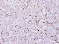 Immunohistochemistry: EPH Receptor A8 Antibody [NBP1-31669] - EPH Receptor A8 Antibody Immunohistochemical analysis of paraffin-embedded H661 xenograft, using EPH receptor A8 antibody at 1:100 dilution.