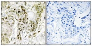 Immunohistochemistry-Paraffin: BCOR Antibody [NBP1-68235] - Analysis of paraffin-embedded human breast carcinoma tissue, using BCOR Antibody. The picture on the right is treated with the synthesized peptide.