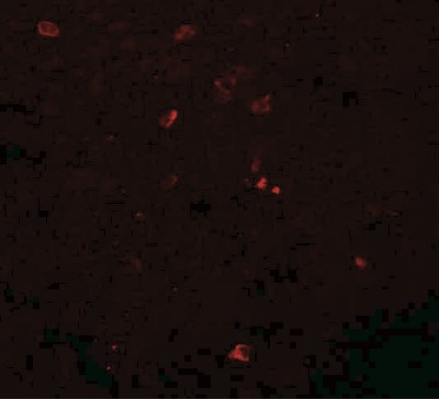 Immunofluorescence: Breast carcinoma amplified sequence 3 Antibody [NBP1-77125] - Human breast carcinoma tissue at 20 ug/mL.