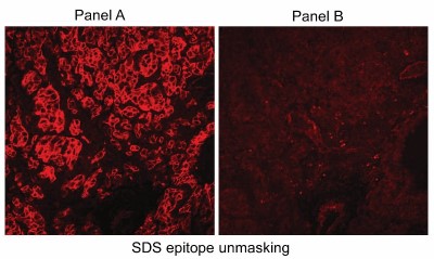 Immunocytochemistry/Immunofluorescence: Carbonic Anhydrase IX/CA9 Antibody [NB100-417] - Immunofluorescence of human RCC tumor cryosections using NB100-417 (Panel A). Panel B shows staining with normal rabbit serum.