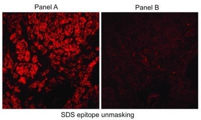 Immunocytochemistry/Immunofluorescence: Carbonic Anhydrase IX/CA9 Antibody [NB100-417] - Analysis of Biotin conjugate of NB100-417. Human RCC tumor cryosections using NB100-417 (Panel A). Panel B shows staining with normal rabbit serum.