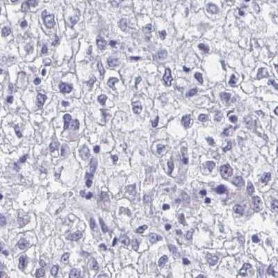 Immunohistochemistry: Importin-9 Antibody [NBP2-31588] - Liver cancer