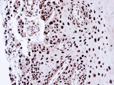 Immunohistochemistry-Paraffin: PA28 Activator gamma Subunit/PSME3 Antibody [NBP1-33498] -  Paraffin-embedded CA922 xenograft, using antibody at 1:100 dilution.