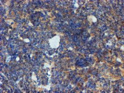 Immunohistochemistry-Paraffin: Phosphoribosyl Pyrophosphate Amidotransferase Antibody (1B8) [NBP2-02056] - Staining of paraffin-embedded Human lymphoma tissue using anti-Phosphoribosyl Pyrophosphate Amidotransferase mouse monoclonal antibody.