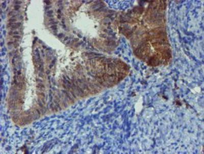 Immunohistochemistry-Paraffin: Phosphoribosyl Pyrophosphate Amidotransferase Antibody (1B8) [NBP2-02056] - Staining of paraffin-embedded Adenocarcinoma of Human endometrium tissue using anti-Phosphoribosyl Pyrophosphate Amidotransferase mouse monoclonal antibody.