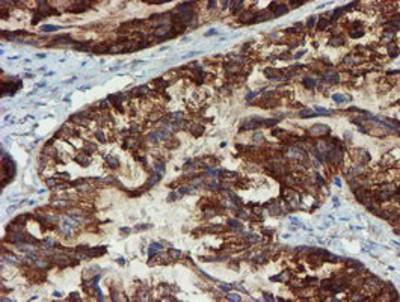 Immunohistochemistry-Paraffin: Phosphoribosyl Pyrophosphate Amidotransferase Antibody (1B8) [NBP2-02056] - Staining of paraffin-embedded Adenocarcinoma of Human ovary tissue using anti-Phosphoribosyl Pyrophosphate Amidotransferase mouse monoclonal antibody.