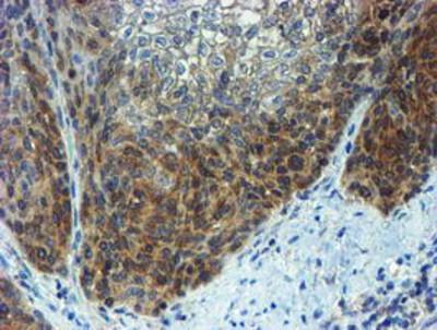 Immunohistochemistry-Paraffin: Phosphoribosyl Pyrophosphate Amidotransferase Antibody (1B8) [NBP2-02056] - Staining of paraffin-embedded Carcinoma of Human bladder tissue using anti-Phosphoribosyl Pyrophosphate Amidotransferase mouse monoclonal antibody.